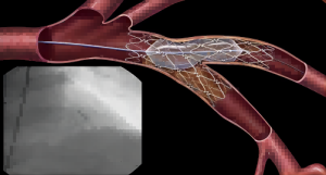 laser-cutting-cardiovascular-stent